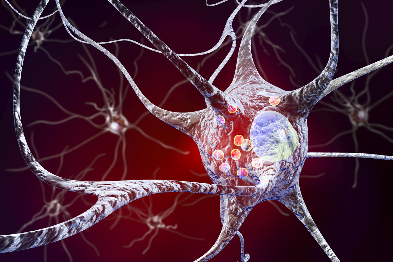 Brain protein overactive in Parkinson’s disease