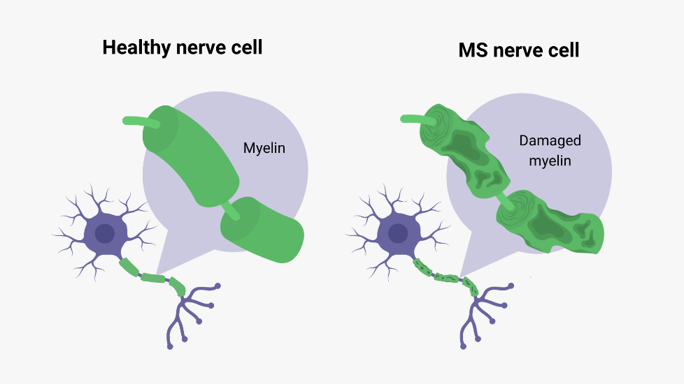Side-by-side comparison of two neurons. The left neuron is healthy, with a thick, intact layer of myelin wrapping its axon. The right neuron shows a multiple sclerosis (MS)-affected neuron, where the myelin is visibly damaged and thinned, exposing parts of the axon.